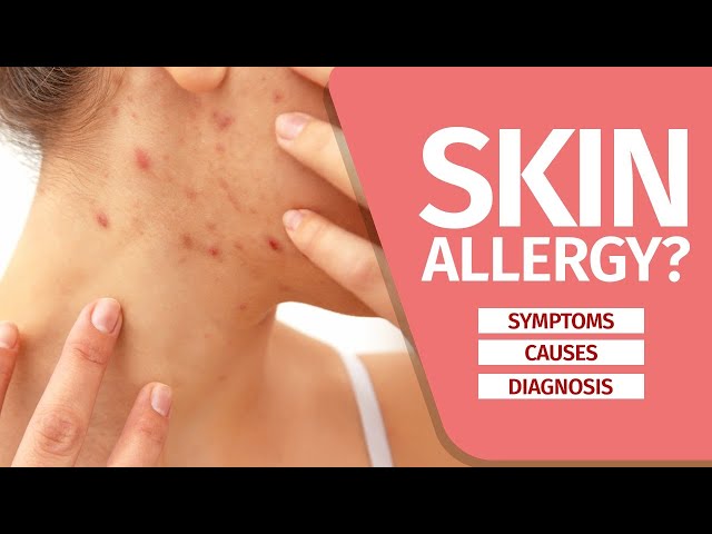 “Which soap will work best for those with skin allergy-related problems?